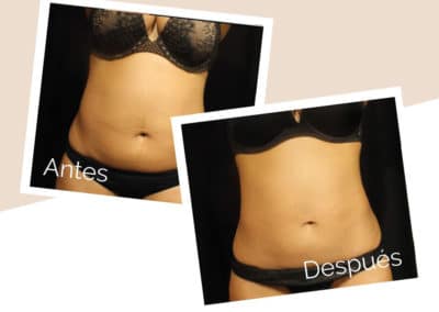 esculpir tu cuerpo con emsculpt