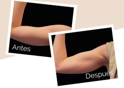 esculpir tu cuerpo con emsculpt