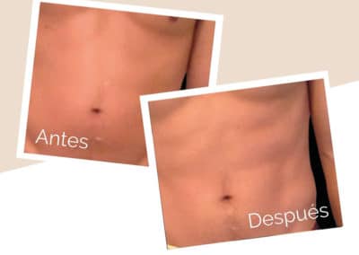 esculpir tu cuerpo con emsculpt