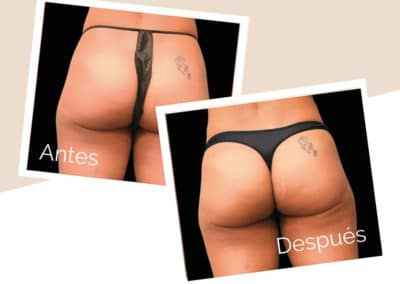 esculpir tu cuerpo con emsculpt