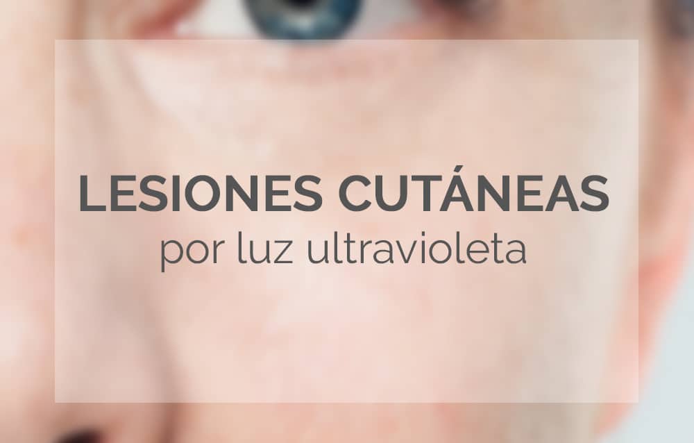 Lesiones Cutáneas por Luz Ultravioleta