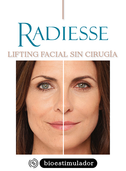 Lifting Facial Sin Cirugía Radiesse