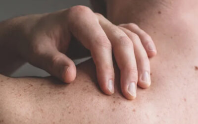 Melanoma: alerta sobre incremento en mortalidad