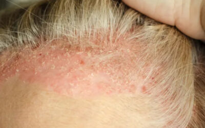 Día mundial de la Psoriasis: conoce los detalles de esta condición cutánea