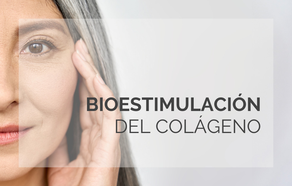 Bioestimulación del colágeno.