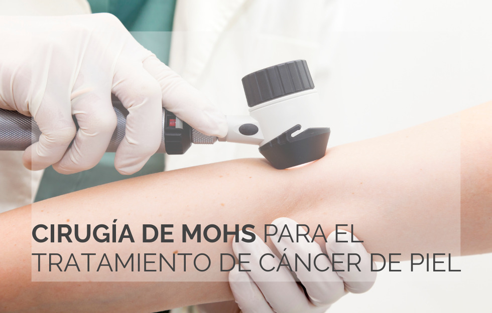 Cirugía de Mohs: una técnica altamente eficaz para el tratamiento de cáncer de piel