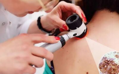 Técnica Avanzada: Cirugía de Mohs para tratamiento de cáncer de piel