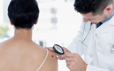 Prevención del Melanoma: concientización y cuidados para la piel