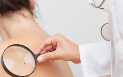 Prevención y Tratamientos Avanzados para el Cáncer de Piel