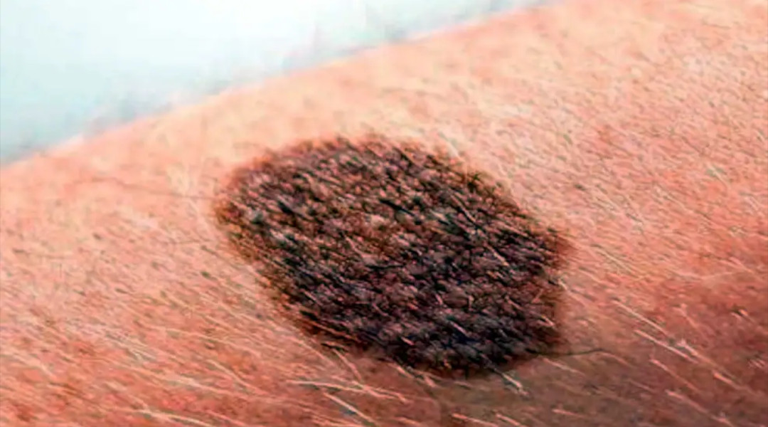 Concientización sobre melanoma en el Día Mundial con control dermatológico