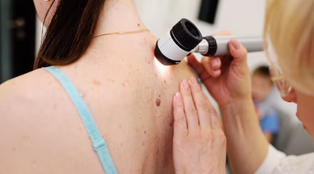 Persona revisando un lunar en la espalda en control dermatológico