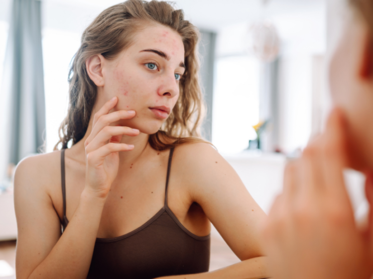 Cuidado facial para prevenir y tratar el acné y evitar marcas