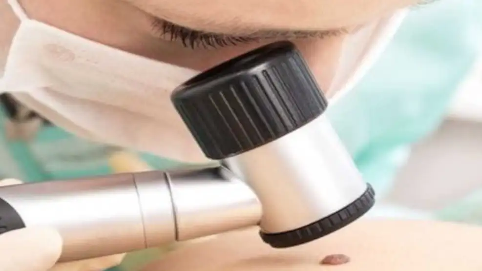 Día Mundial del Cáncer de Piel