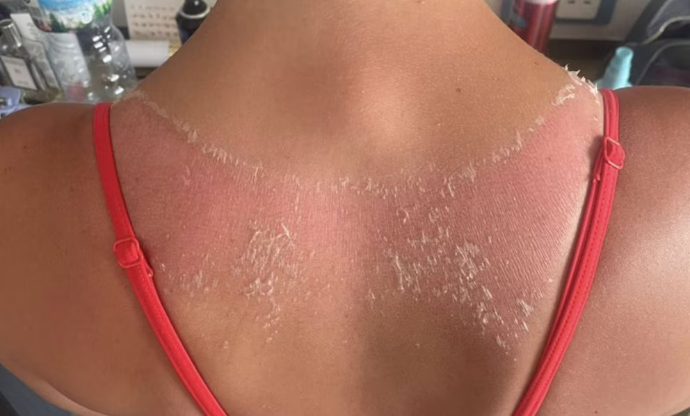 Piel irritada por contacto con prenda textil sintética