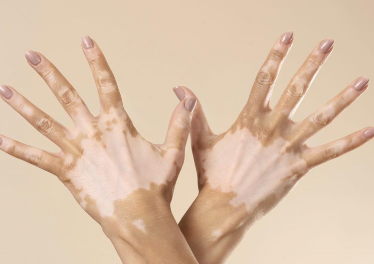 ¿Qué es el vitiligo? La enfermedad que deja marcas blancas en la piel… y mucho más