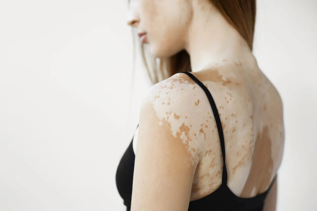 Mujer con vitiligo mostrando manchas blancas en la piel