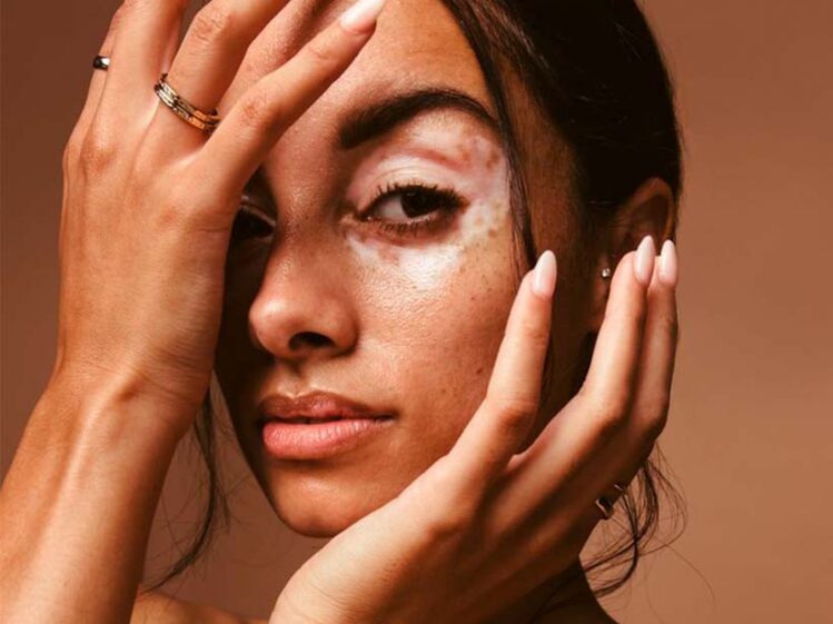 Piel con manchas blancas por vitiligo mostrando diversidad