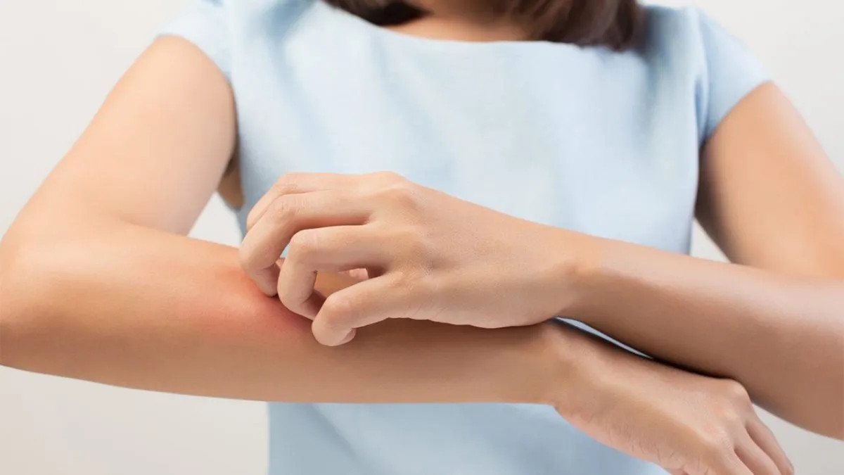 Piel con enrojecimiento e irritación por dermatitis atópica