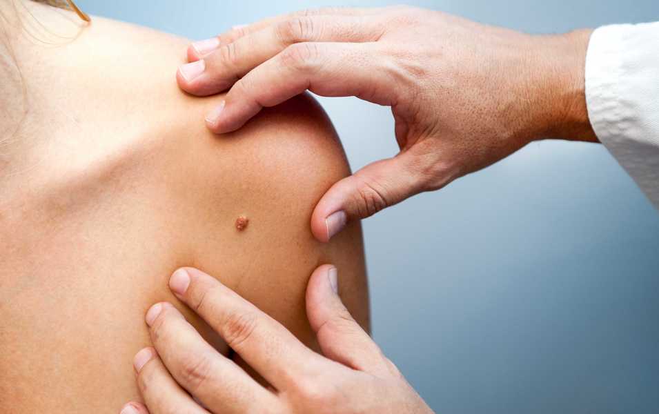 Diagnóstico de cáncer de piel: qué hacer y cómo cuidarse tras el diagnóstico