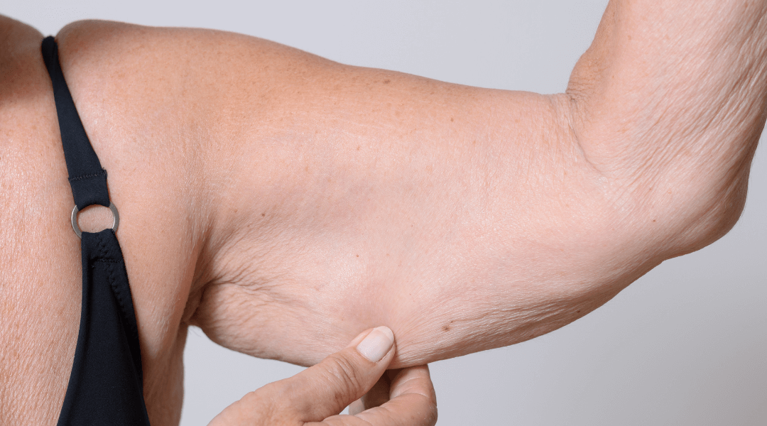 Tratamientos efectivos para la flacidez facial y corporal: qué hacer y cuándo empezar