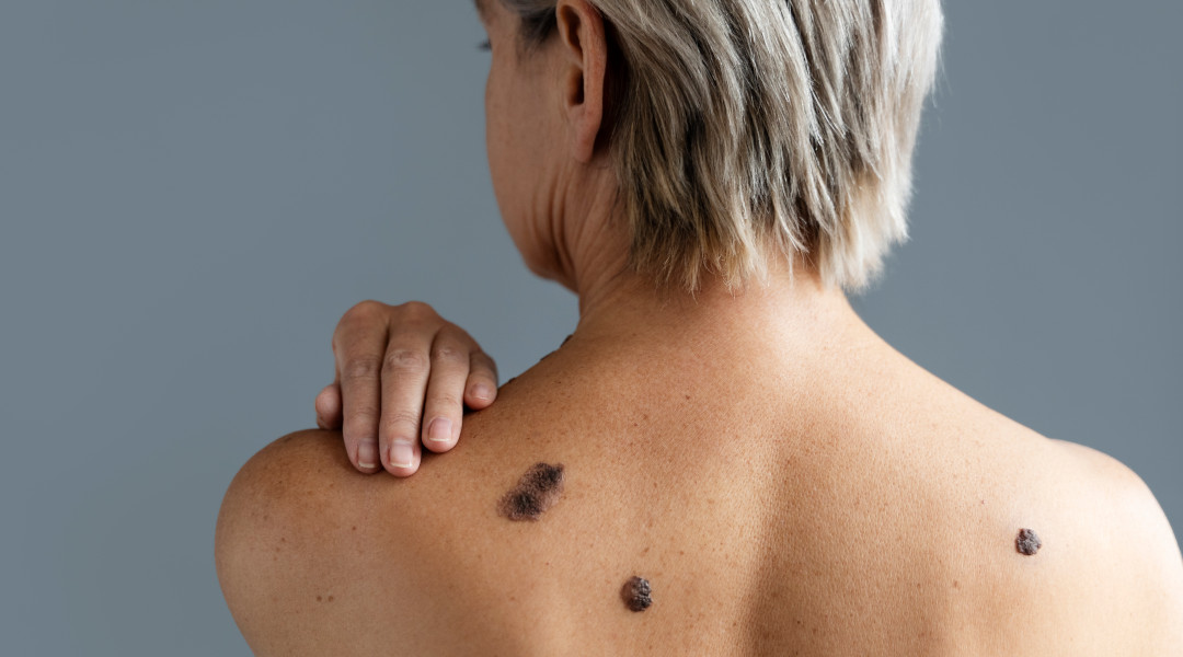 Cirugía de Mohs: el tratamiento más preciso para el tumor basocelular