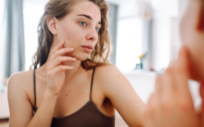 Acné: cómo prevenirlo, tratarlo y evitar que deje marcas