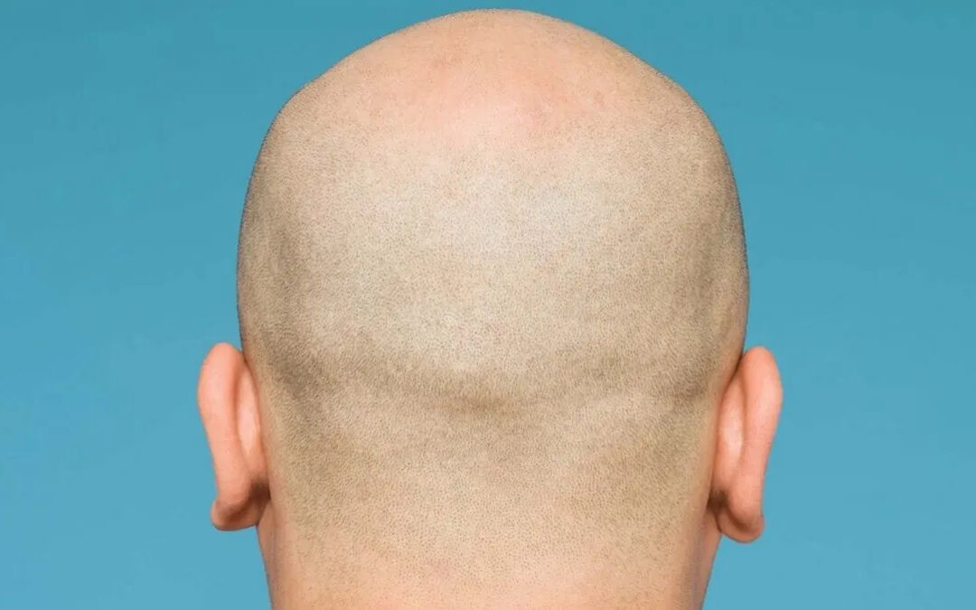 Cómo frenar la alopecia y fortalecer el cabello, según dermatóloga