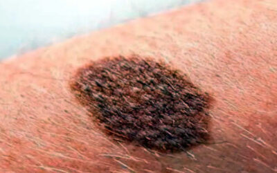 Día Mundial del Melanoma