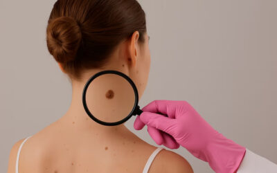 Día Mundial del Cáncer de Piel: cuáles son los síntomas y cómo prevenirlos