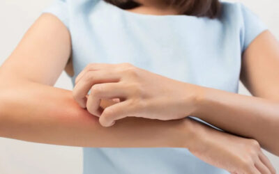 Dermatitis atópica: Un problema de la piel que no debe ser subestimado