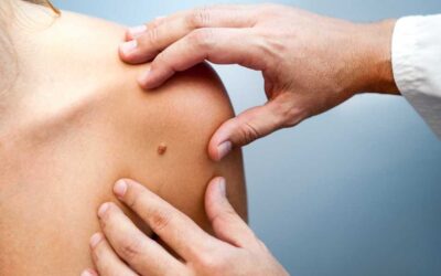 Diagnóstico de cáncer de piel: qué hacer y cómo cuidarse tras el diagnóstico