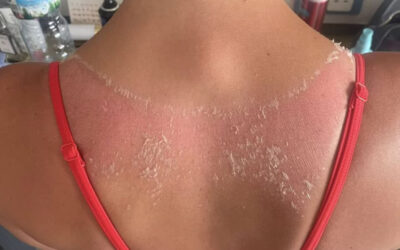 Una joven británica mostró lastimaduras en la piel por un top que compró en Shein: cómo prevenir reacciones cutáneas