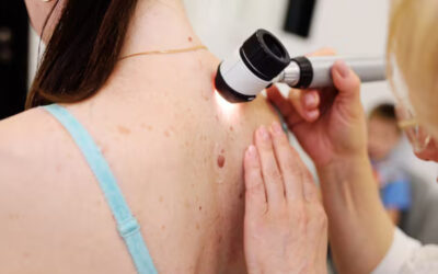 Melanoma: lo que aprendimos, lo que aún podemos cambiar