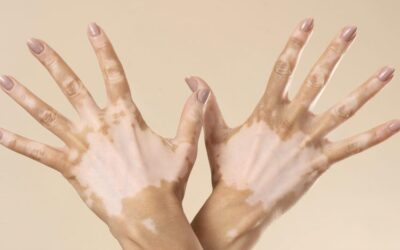 ¿Qué es el vitiligo? La enfermedad que deja marcas blancas en la piel… y mucho más