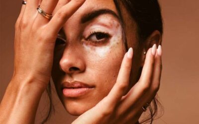 Vitiligo: qué es, a quién afecta y por qué deja marcas más allá de la piel